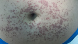 腹型过敏性紫癜 腹型过敏性紫癜