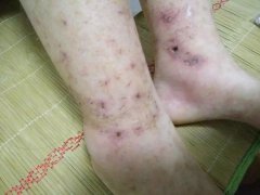 腹型紫癜怎么办？为什么过敏性紫癜会引起腹痛?