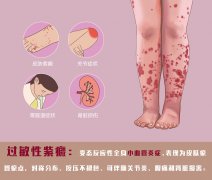 紫癜名医李玉：紫癜复发咱不怕，临床规范化诊疗帮你忙！