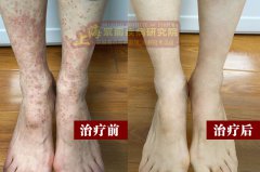 上海紫癜医院：难治性过敏性紫癜的治疗方法有哪些?